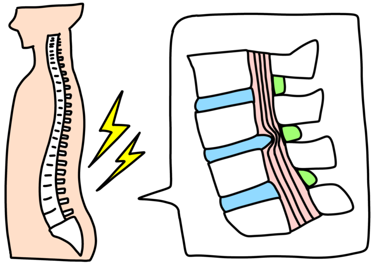 腰椎椎間板ヘルニアの図